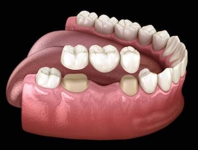 Dental crowns combined with a dental bridge