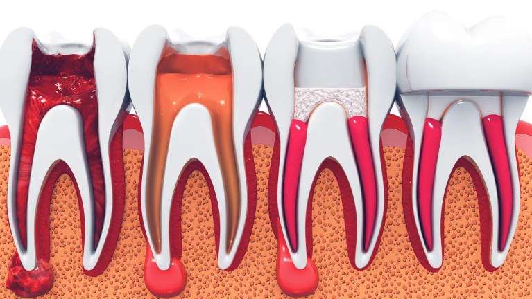 Different type of infected tooth nerve in Winchester KY