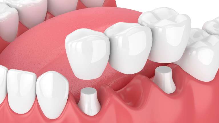 Dental Bridge diagram | Bridges Winchester KY